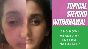 TSW skin condition showing red, inflamed skin caused by topical steroid withdrawal in an eczema patient — BBC news feature