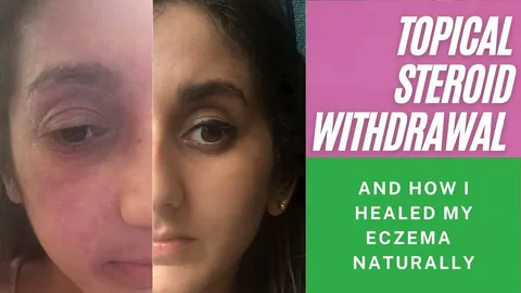 TSW skin condition showing red, inflamed skin caused by topical steroid withdrawal in an eczema patient — BBC news feature