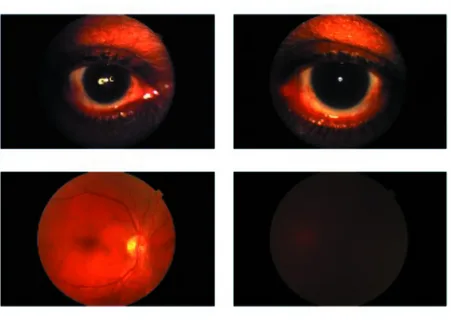 Close-up of retinal imaging AI scan being used to detect early signs of dementia and Alzheimer's disease through corneal nerve analysis