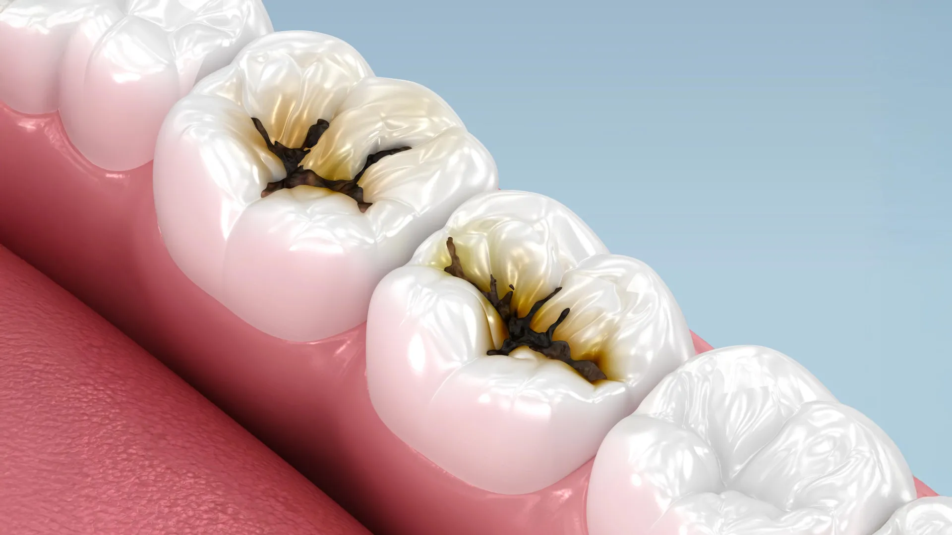 Image Alt Text Dentist applying Silver Diamine Fluoride treatment to stop tooth decay in a young child's baby tooth.
